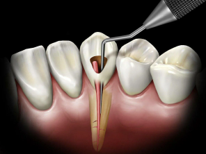 Лечение пульпита